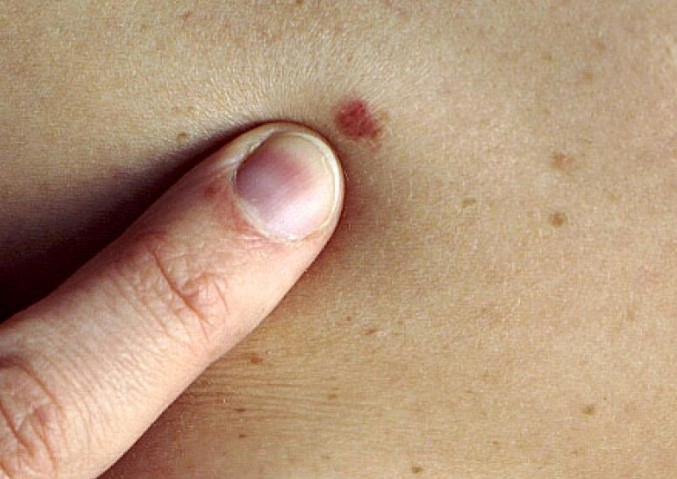 피부암 수술사례