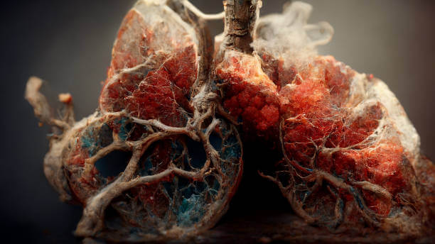 폐에 물이 차는 이유, 폐부종 증상과 원인 치료. 폐부종은 심장이나 호흡기 문제로 인해 폐에 비정상적인 수량의 물이 쌓여 발생하는 질환으로, 호흡곤란과 부종 등 다양한 증상을 유발합니다. 어떤 과정이 있는지 글을 참고해주세요.