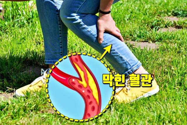 종아리 굵기 건강, 종아리가 당기는 이유, 팁줌