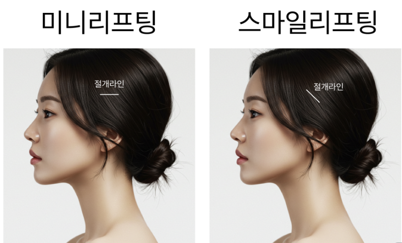 미니리프팅 스마일리프팅 신사역성형외과 윤곽개선