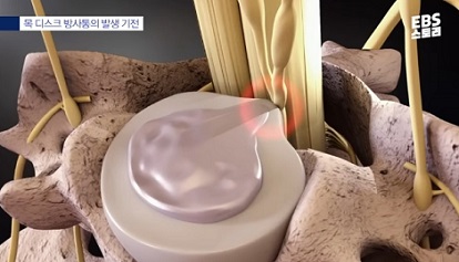 목디스크손상과정