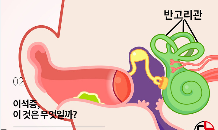 이석증 원인