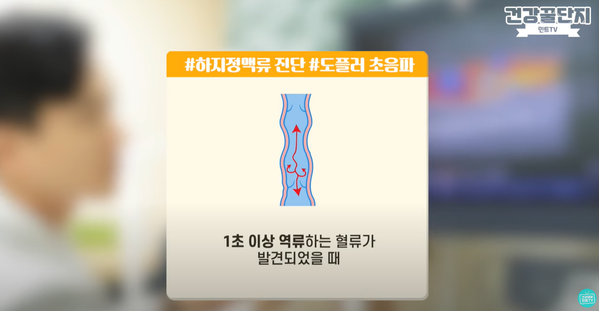 1초 이상 역류하는 혈류가 있으면 하지정맥류