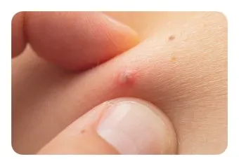 엉덩이 종기가 생기는 이유 왜 생기고 어떻게 관리할까요 완벽 가이드_10