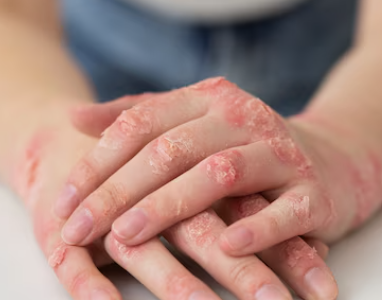 대상포진 초기증상 4