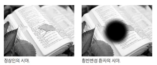 시야에 검은점 시야에 까만점이 보일때 원인과 대처법_5