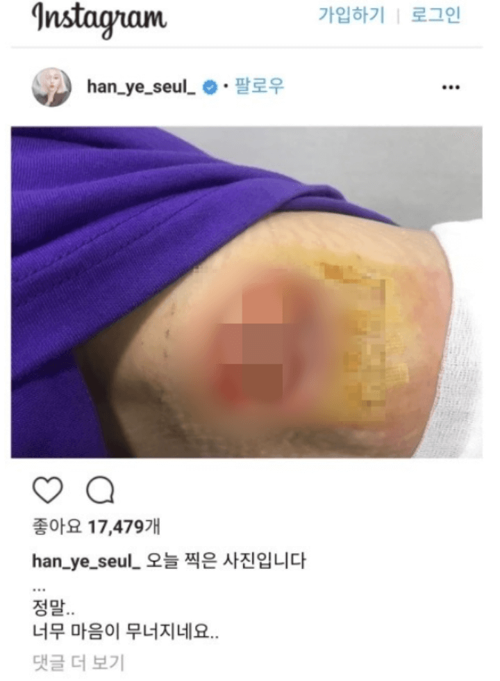 한예슬-지방종제거-차병원수술-흉터-인스타그램