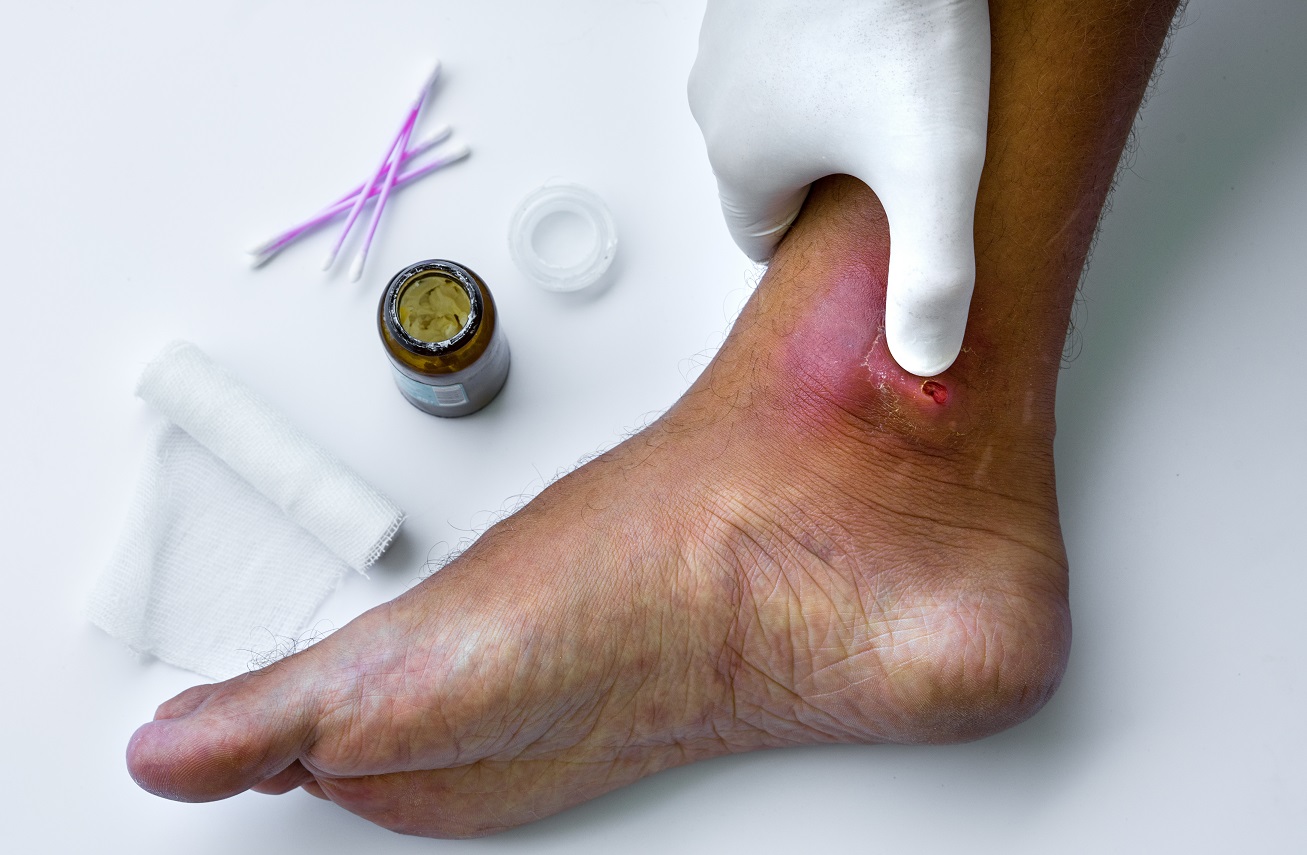 염증의 원인과 염증에 좋은 음식