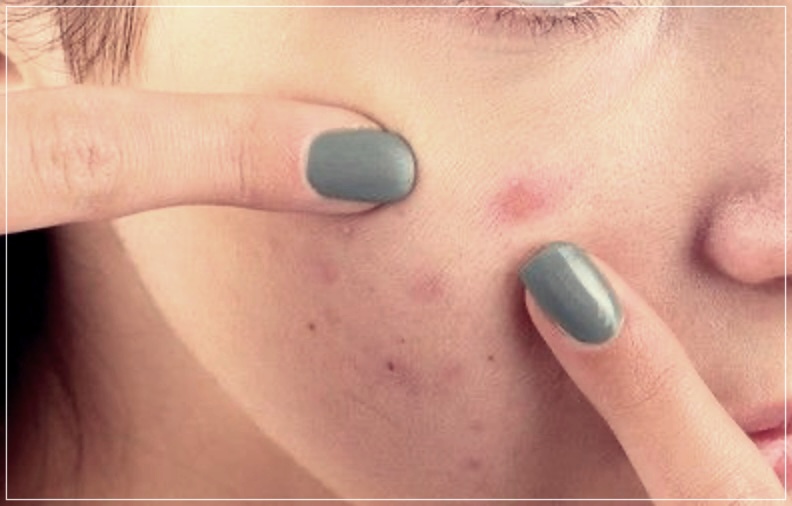 결절성 여드름 관리 잘하는 방법 3가지