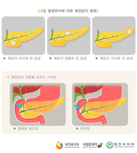 췌장암에 좋은 음식