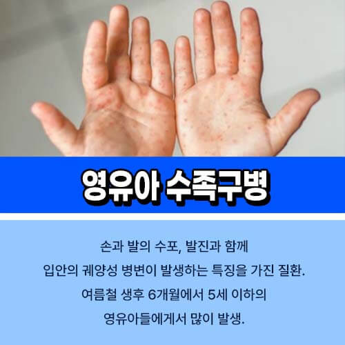 영유아 수족구병