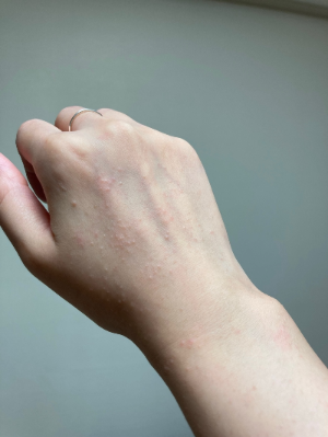 햇빛 알레르기 증상