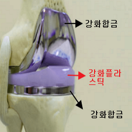 무릎연골 수술 후 모습