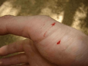 산에-갔다가-뱀에게-엄지손가락-팔목쪽을-물려-이빨자국-두개가-선명히-있는-모습