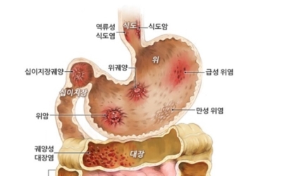 식도암이미지