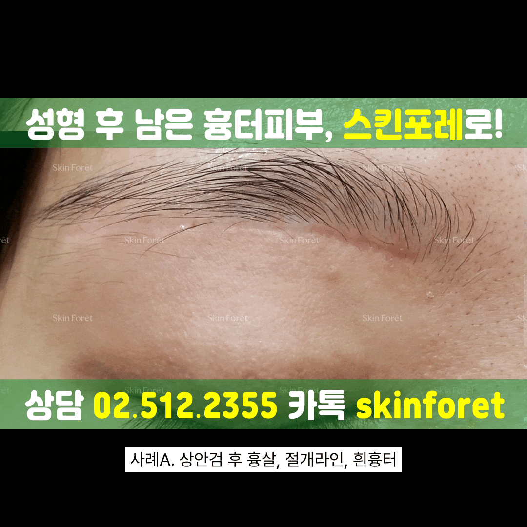 중년 눈성형 전후, 상안검 흉터 개선 사례