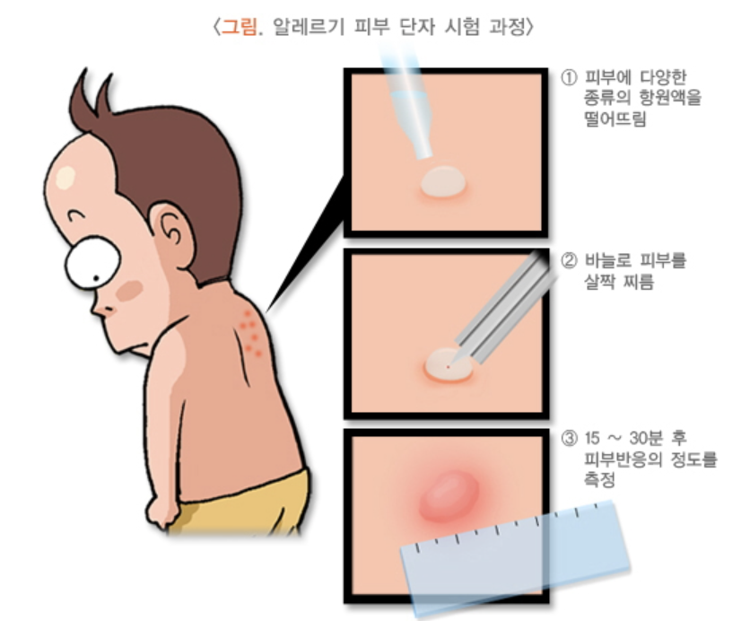 알레르기 피부 단자 시험