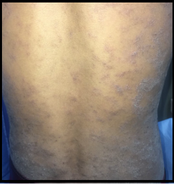 "옴" 감염환자의 피부 사진