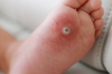 사마귀 제거방법 연고 추천 사마귀 냉동치료 원인 실비보험