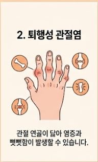 류마티스 관절염 초기증상