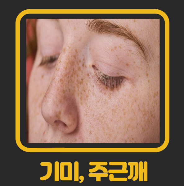 멜라닌 색소 과다로 생기는 기미와 주근깨