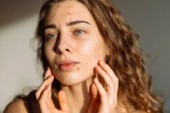 생리 전 뾰루지 폭발 원인과 해결법 7가지 생리 전후 뾰루지 발생 이유 완벽 분석_13