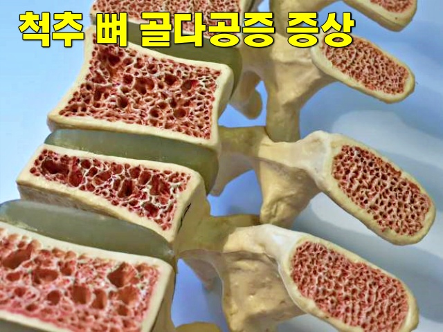 골다공증 골절 단백질 부족 증상,단백질 부족을 알리는 우리 몸의 7가지 신호,건강 팁줌