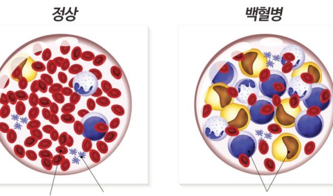 백혈구 정상 수치