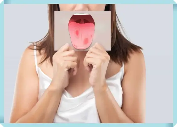 혓바늘 증상과 예방