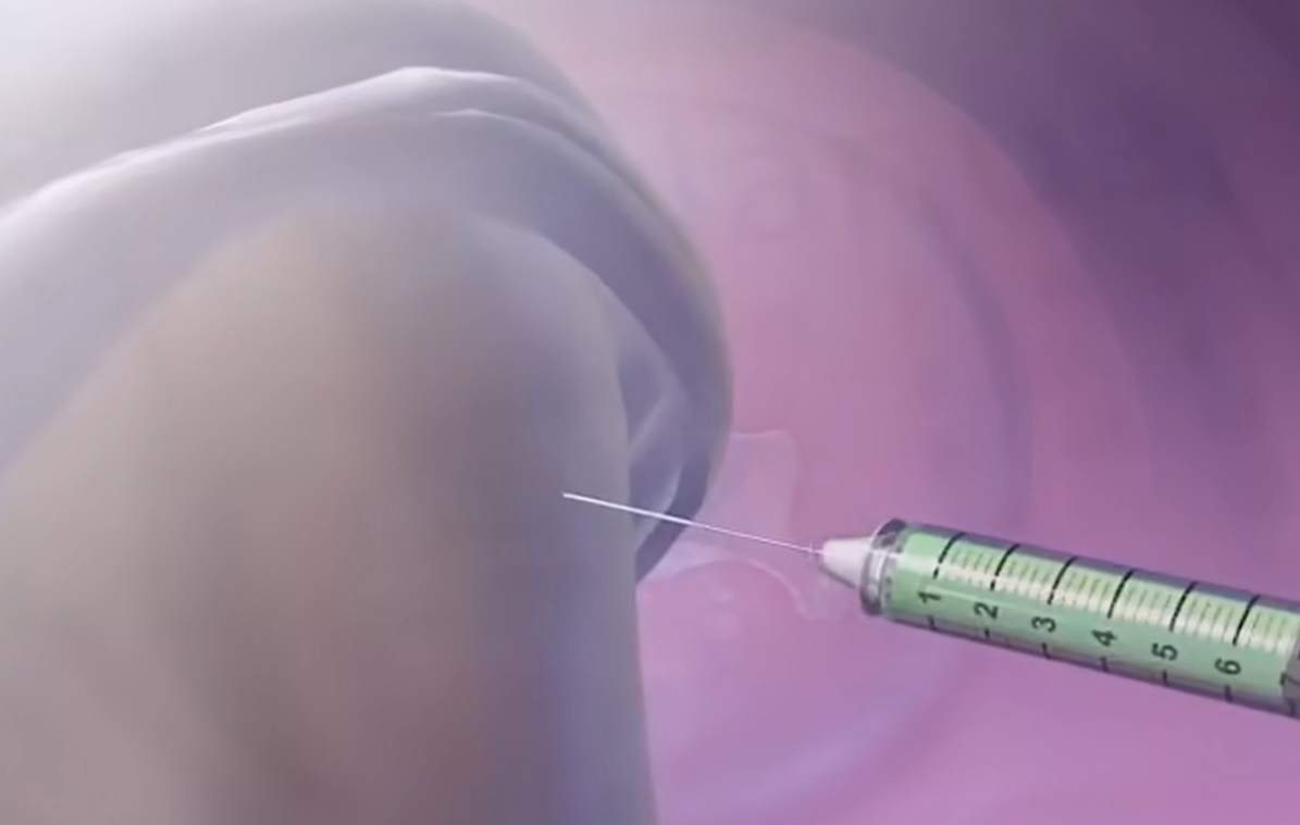 hpv 바이러스 증상