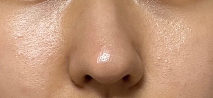 성분에디터 그린토마토 포어리프팅 앰플플러스 사용 2주차(6/17사진)