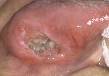 설암(혀암) 초기증상과 원인