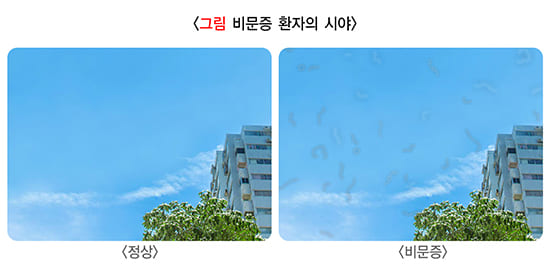 비문증 시야