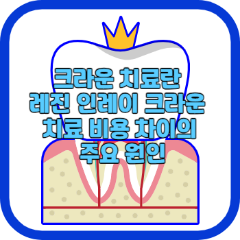 크라운 치료란 레진 인레이 크라운 치료 비용 차이의 주요 원인