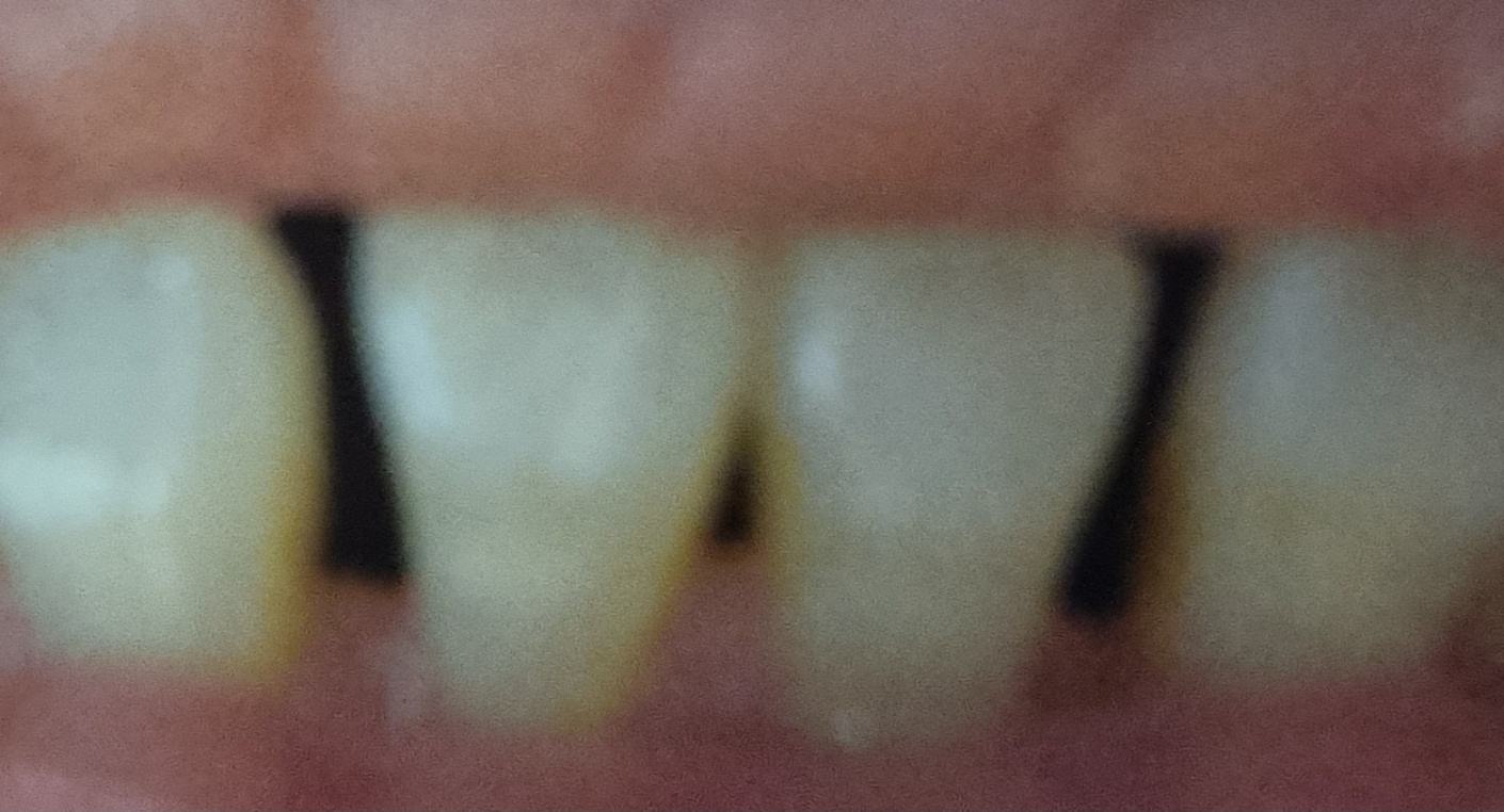 치주염 증상과 치료법