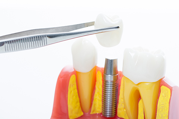 임플란트 비용 의료보험