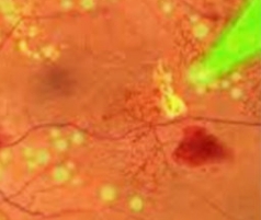 황반변성 자가진단&amp;#44; 치료법&amp;#44; 주사치료 가격