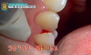 잇몸염증