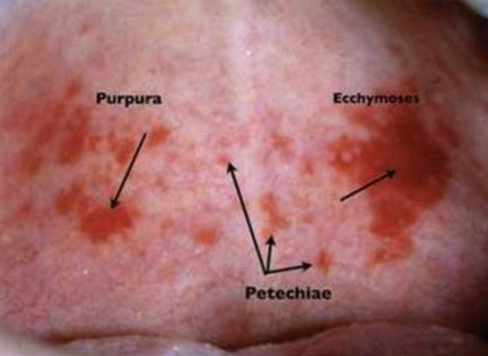 피부출혈 구분법