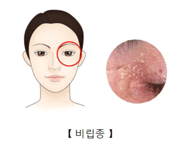 비립종