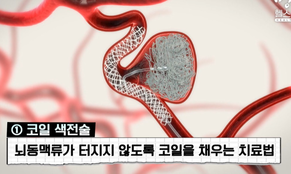 뇌동맥류-윤원기-의사-코일색전술
