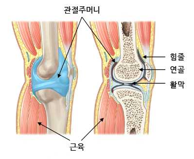 관절염 초기증상