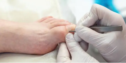 내성발톱 관련 사진