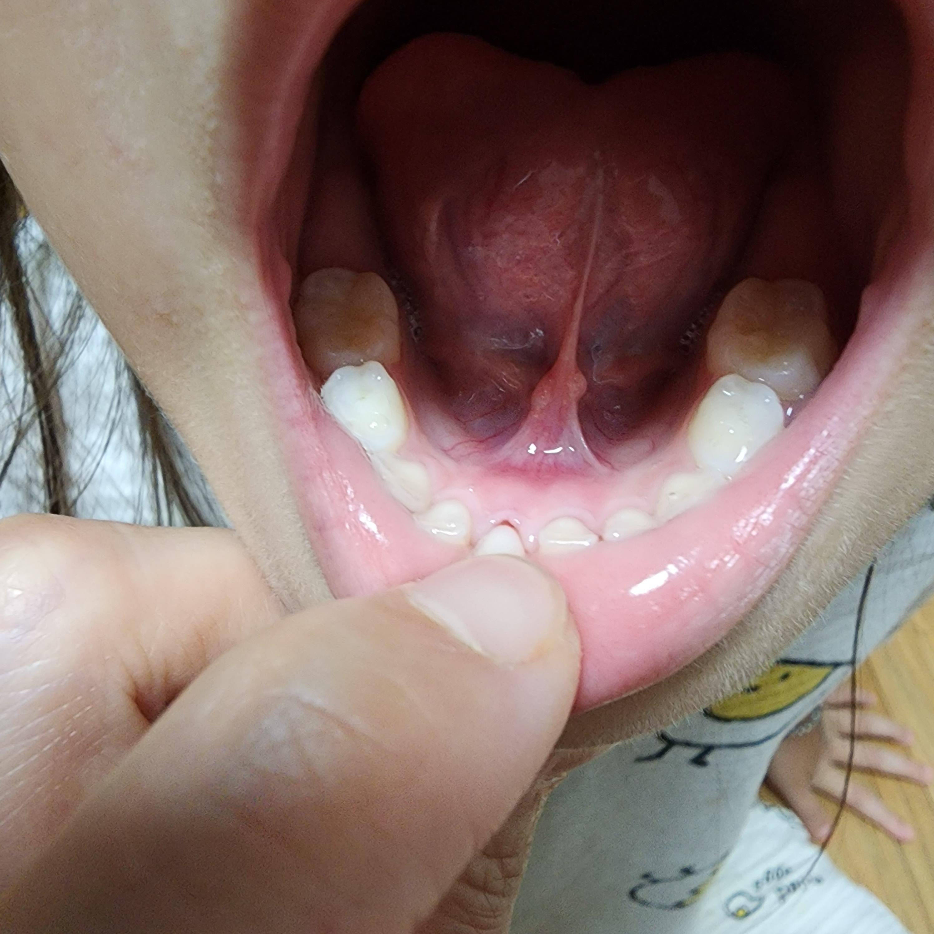 안아프게이빨뽑기