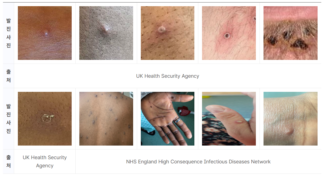 엠폭스 증상 감염경로