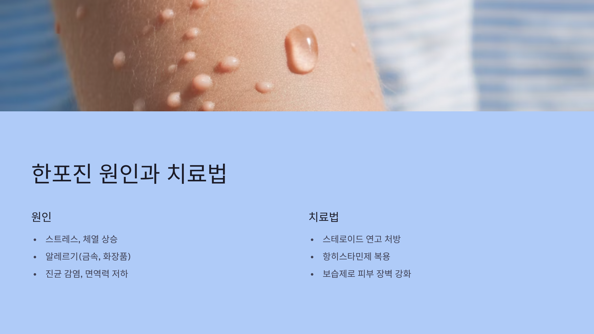 한포진 원인과 치료법