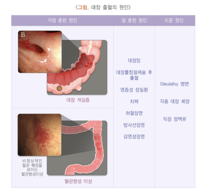 대장 출혈의 원인