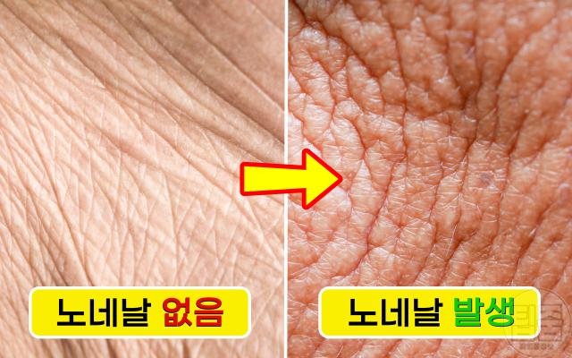 노인냄새 원인 제거 노네날 피부 지질 변화