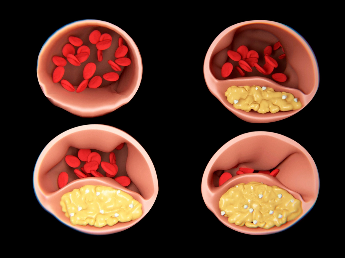 혈관 콜레스테롤