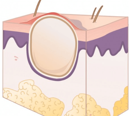 남자, 여자 생식기 피지낭종, 원인, 제거 수술 비용